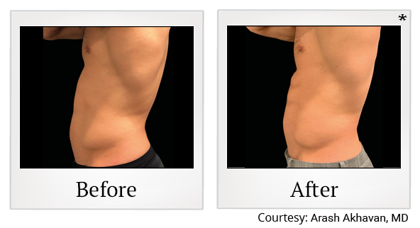 Before and After Photo 19 of Emsculpt® treatment at SF Bay Cosmetic Surgery Medical Group in San Ramon