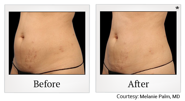 Before and After Photo 22 of Emsculpt® treatment at SF Bay Cosmetic Surgery Medical Group in San Ramon