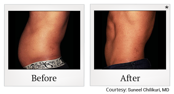 Before and After Photo 24 of Emsculpt® treatment at SF Bay Cosmetic Surgery Medical Group in San Ramon