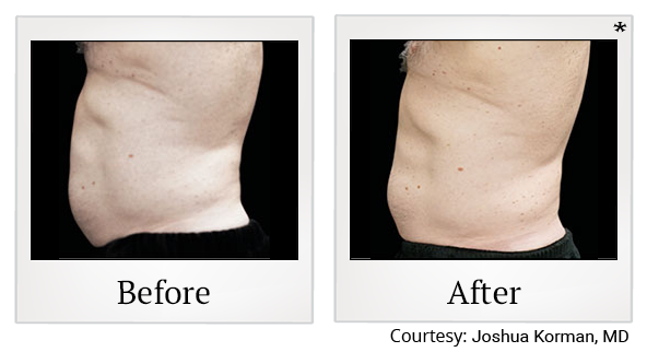 Before and After Photo 28 of Emsculpt® treatment at SF Bay Cosmetic Surgery Medical Group in San Ramon