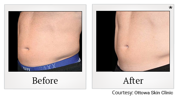 Before and After Photo 35 of Emsculpt® treatment at SF Bay Cosmetic Surgery Medical Group in San Ramon