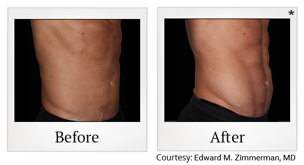 Before and After Photo 2 of Emsculpt® treatment at SF Bay Cosmetic Surgery Medical Group in San Ramon