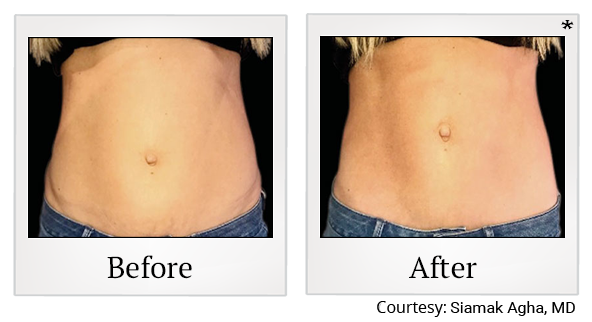 Before and After Photo 39 of Emsculpt® treatment at SF Bay Cosmetic Surgery Medical Group in San Ramon