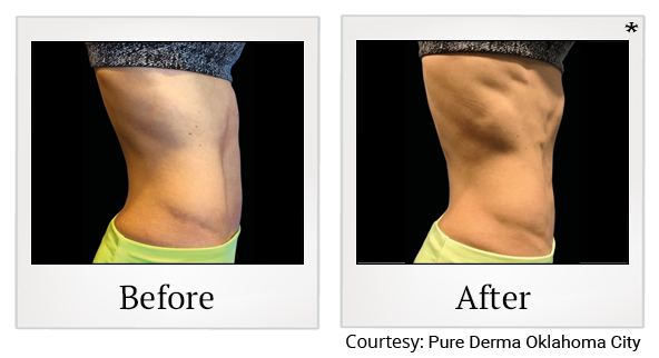 Before and After Photo 44 of Emsculpt® treatment at SF Bay Cosmetic Surgery Medical Group in San Ramon