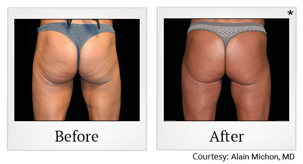 Before and After Photo5 0 of Emsculpt® treatment at SF Bay Cosmetic Surgery Medical Group in San Ramon