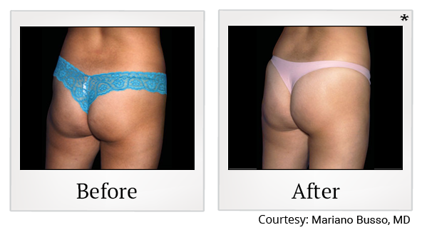 Before and After Photo 51 of Emsculpt® treatment at SF Bay Cosmetic Surgery Medical Group in San Ramon