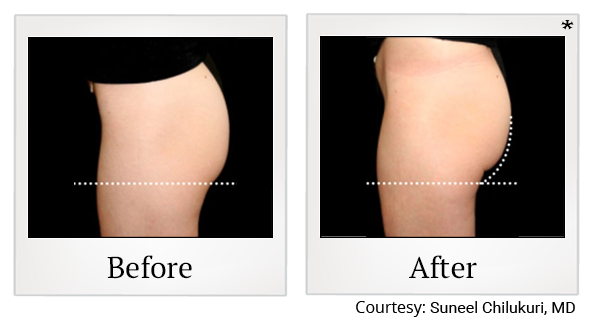 Before and After Photo 52 of Emsculpt® treatment at SF Bay Cosmetic Surgery Medical Group in San Ramon