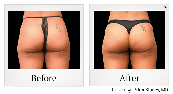 Before and After Photo 53 of Emsculpt® treatment at SF Bay Cosmetic Surgery Medical Group in San Ramon