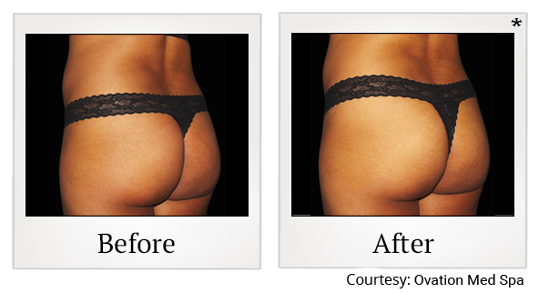 Before and After Photo 54 of Emsculpt® treatment at SF Bay Cosmetic Surgery Medical Group in San Ramon