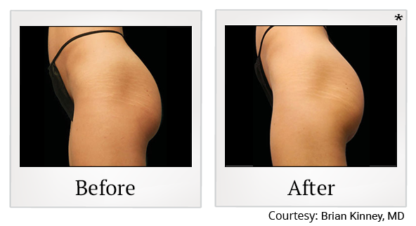 Before and After Photo 56 of Emsculpt® treatment at SF Bay Cosmetic Surgery Medical Group in San Ramon