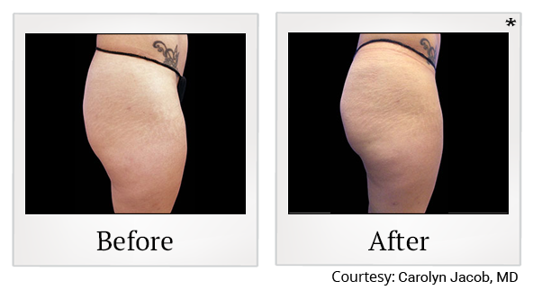 Before and After Photo 58 of Emsculpt® treatment at SF Bay Cosmetic Surgery Medical Group in San Ramon