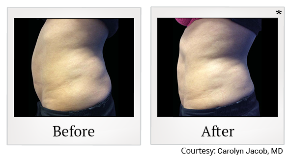Before and After Photo 6 of Emsculpt® treatment at SF Bay Cosmetic Surgery Medical Group in San Ramon