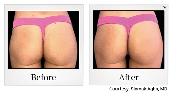Before and After Photo 60 of Emsculpt® treatment at SF Bay Cosmetic Surgery Medical Group in San Ramon