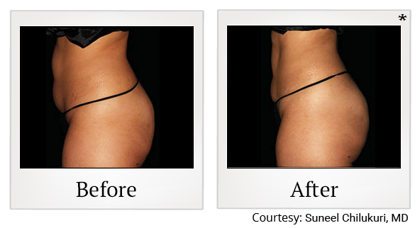 Before and After Photo 61 of Emsculpt® treatment at SF Bay Cosmetic Surgery Medical Group in San Ramon