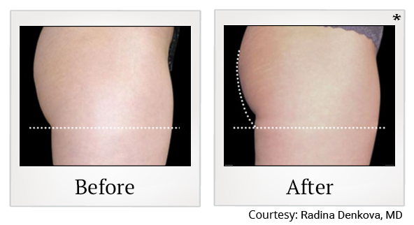 Before and After Photo 62 of Emsculpt® treatment at SF Bay Cosmetic Surgery Medical Group in San Ramon