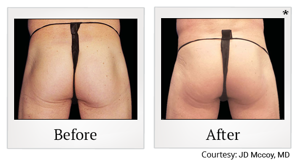 Before and After Photo 64 of Emsculpt® treatment at SF Bay Cosmetic Surgery Medical Group in San Ramon