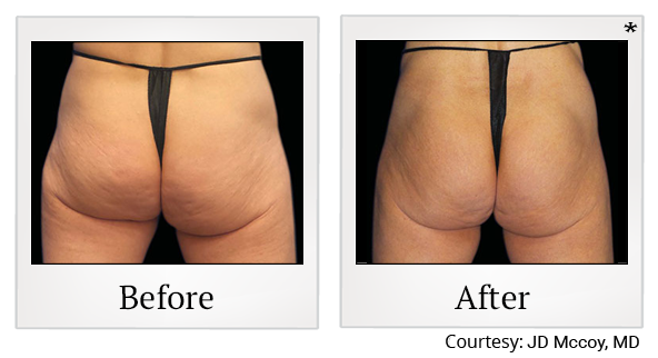 Before and After Photo 65 of Emsculpt® treatment at SF Bay Cosmetic Surgery Medical Group in San Ramon