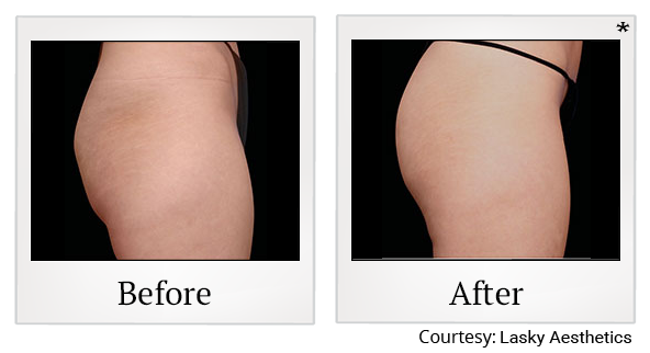 Before and After Photo 66 of Emsculpt® treatment at SF Bay Cosmetic Surgery Medical Group in San Ramon