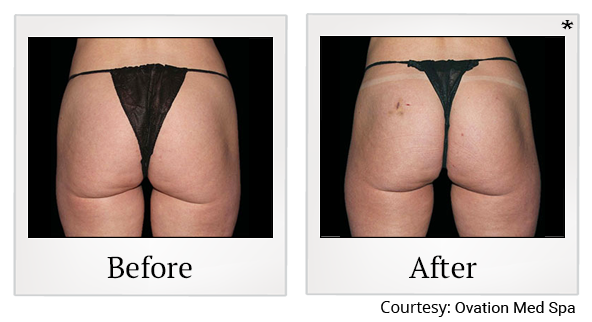 Before and After Photo 67 of Emsculpt® treatment at SF Bay Cosmetic Surgery Medical Group in San Ramon