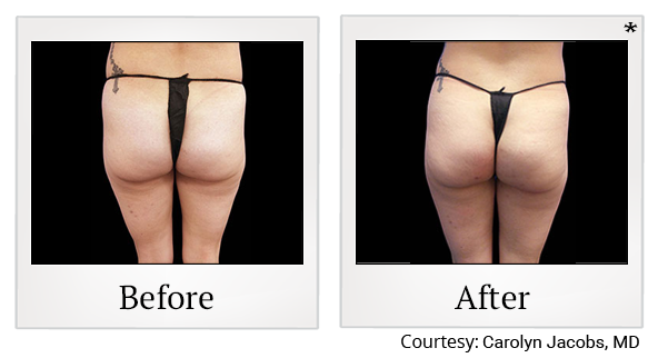 Before and After Photo 68 of Emsculpt® treatment at SF Bay Cosmetic Surgery Medical Group in San Ramon