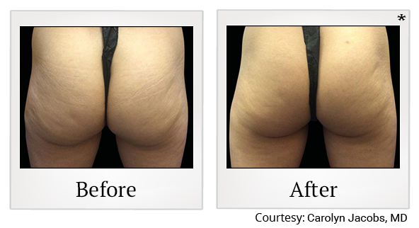 Before and After Photo 69 of Emsculpt® treatment at SF Bay Cosmetic Surgery Medical Group in San Ramon