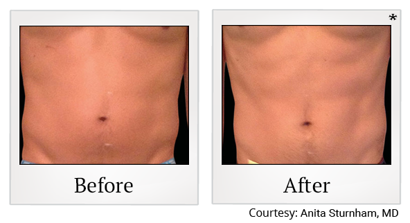 Before and After Photo 7 of Emsculpt® treatment at SF Bay Cosmetic Surgery Medical Group in San Ramon