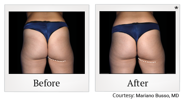 Before and After Photo 70 of Emsculpt® treatment at SF Bay Cosmetic Surgery Medical Group in San Ramon