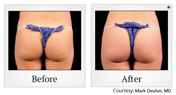 Before and After Photo 73 of Emsculpt® treatment at SF Bay Cosmetic Surgery Medical Group in San Ramon