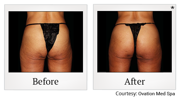 Before and After Photo 74 of Emsculpt® treatment at SF Bay Cosmetic Surgery Medical Group in San Ramon