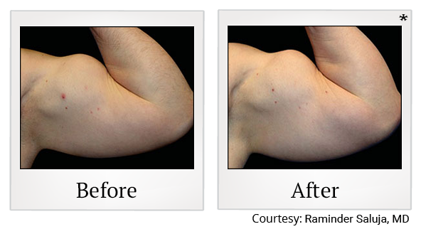Before and After Photo 76 of Emsculpt® treatment at SF Bay Cosmetic Surgery Medical Group in San Ramon