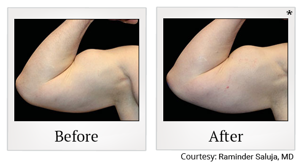 Before and After Photo 78 of Emsculpt® treatment at SF Bay Cosmetic Surgery Medical Group in San Ramon