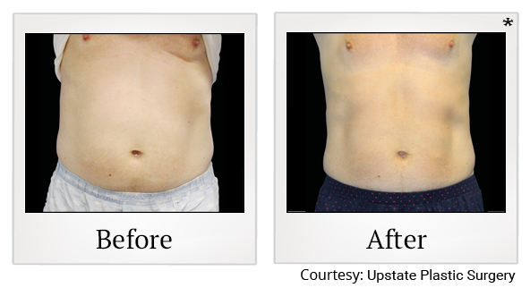 Before and After Photo 8 of Emsculpt® treatment at SF Bay Cosmetic Surgery Medical Group in San Ramon