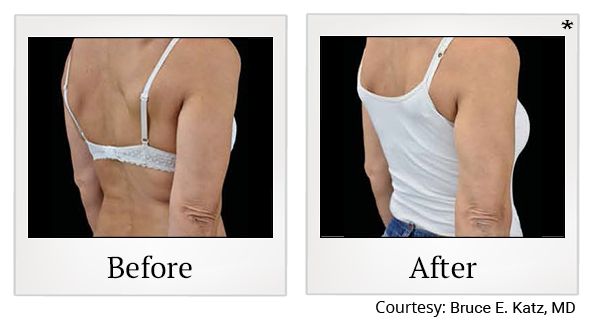 Before and After Photo 80 of Emsculpt® treatment at SF Bay Cosmetic Surgery Medical Group in San Ramon