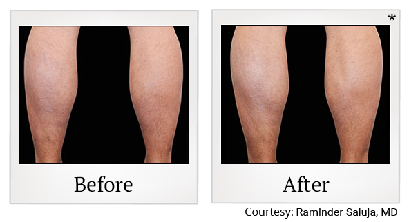 Before and After Photo 5 of Emsculpt® treatment at SF Bay Cosmetic Surgery Medical Group in San Ramon