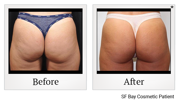Before and After Photo 88 of Emsculpt® treatment at SF Bay Cosmetic Surgery Medical Group in San Ramon