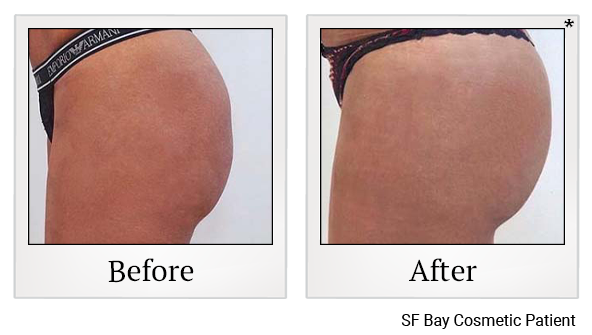 Before and After Photo 91 of Emsculpt® treatment at SF Bay Cosmetic Surgery Medical Group in San Ramon