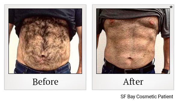 Before and After Photo 93 of Emsculpt® treatment at SF Bay Cosmetic Surgery Medical Group in San Ramon