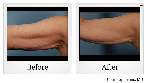Before and After Photo 1 of Exilis Ultra 360™ treatment at SF Bay Cosmetic Surgery Medical Group in San Ramon, Pleasanton, San Jose, and Oakland