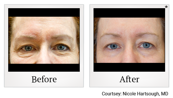 Before and After Photo 11 of Exilis Ultra 360™ treatment at SF Bay Cosmetic Surgery Medical Group in San Ramon, Pleasanton, San Jose, and Oakland