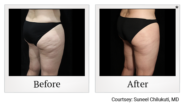 Before and After Photo 12 of Exilis Ultra 360™ treatment at SF Bay Cosmetic Surgery Medical Group in San Ramon, Pleasanton, San Jose, and Oakland