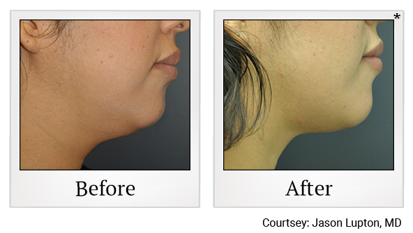 Before and After Photo 13 of Exilis Ultra 360™ treatment at SF Bay Cosmetic Surgery Medical Group in San Ramon, Pleasanton, San Jose, and Oakland