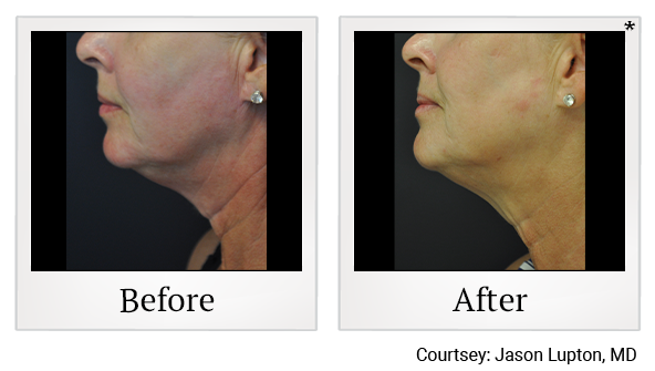 Before and After Photo 14 of Exilis Ultra 360™ treatment at SF Bay Cosmetic Surgery Medical Group in San Ramon, Pleasanton, San Jose, and Oakland