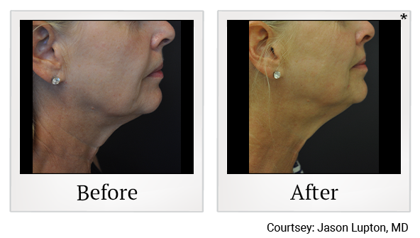 Before and After Photo 15 of Exilis Ultra 360™ treatment at SF Bay Cosmetic Surgery Medical Group in San Ramon, Pleasanton, San Jose, and Oakland