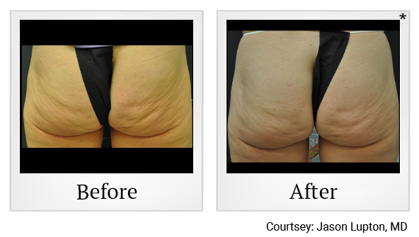 Before and After Photo 16 of Exilis Ultra 360™ treatment at SF Bay Cosmetic Surgery Medical Group in San Ramon, Pleasanton, San Jose, and Oakland