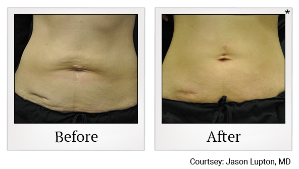 Before and After Photo 17 of Exilis Ultra 360™ treatment at SF Bay Cosmetic Surgery Medical Group in San Ramon, Pleasanton, San Jose, and Oakland
