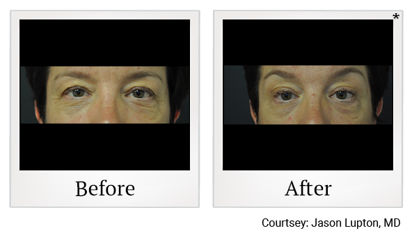 Before and After Photo 18 of Exilis Ultra 360™ treatment at SF Bay Cosmetic Surgery Medical Group in San Ramon, Pleasanton, San Jose, and Oakland