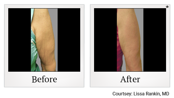 Before and After Photo 2 of Exilis Ultra 360™ treatment at SF Bay Cosmetic Surgery Medical Group in San Ramon, Pleasanton, San Jose, and Oakland