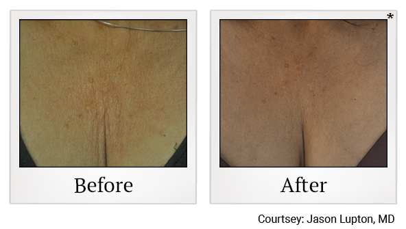 Before and After Photo 20 of Exilis Ultra 360™ treatment at SF Bay Cosmetic Surgery Medical Group in San Ramon, Pleasanton, San Jose, and Oakland
