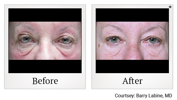 Before and After Photo 22 of Exilis Ultra 360™ treatment at SF Bay Cosmetic Surgery Medical Group in San Ramon, Pleasanton, San Jose, and Oakland