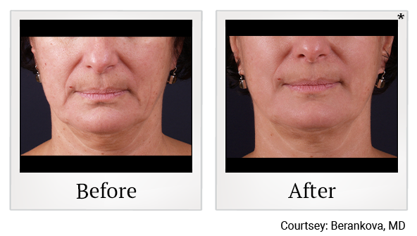 Before and After Photo 23 of Exilis Ultra 360™ treatment at SF Bay Cosmetic Surgery Medical Group in San Ramon, Pleasanton, San Jose, and Oakland